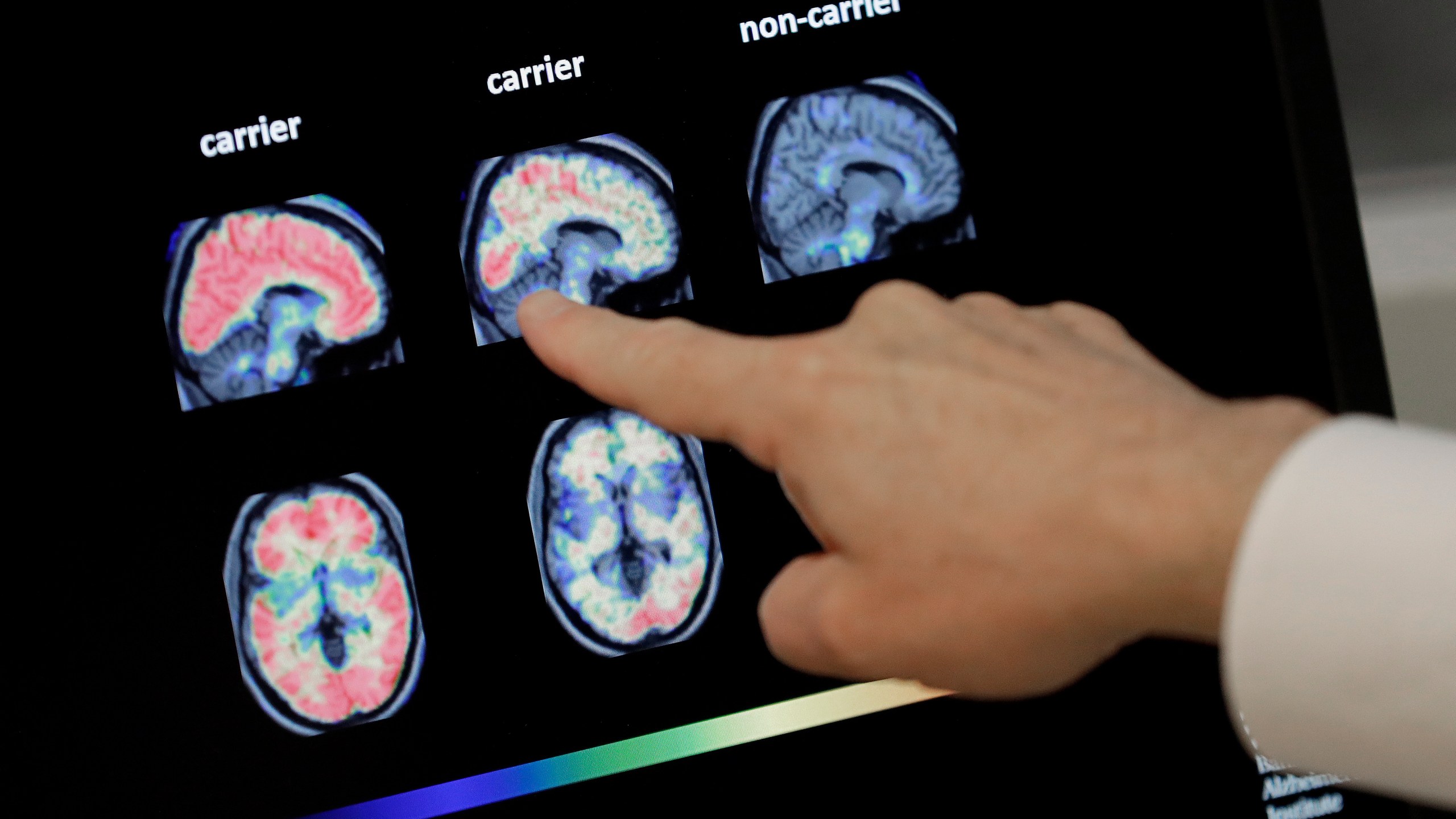 FILE - A doctor looks at PET brain scans at Banner Alzheimers Institute in Phoenix on Aug. 14, 2018. (AP Photo/Matt York, File)