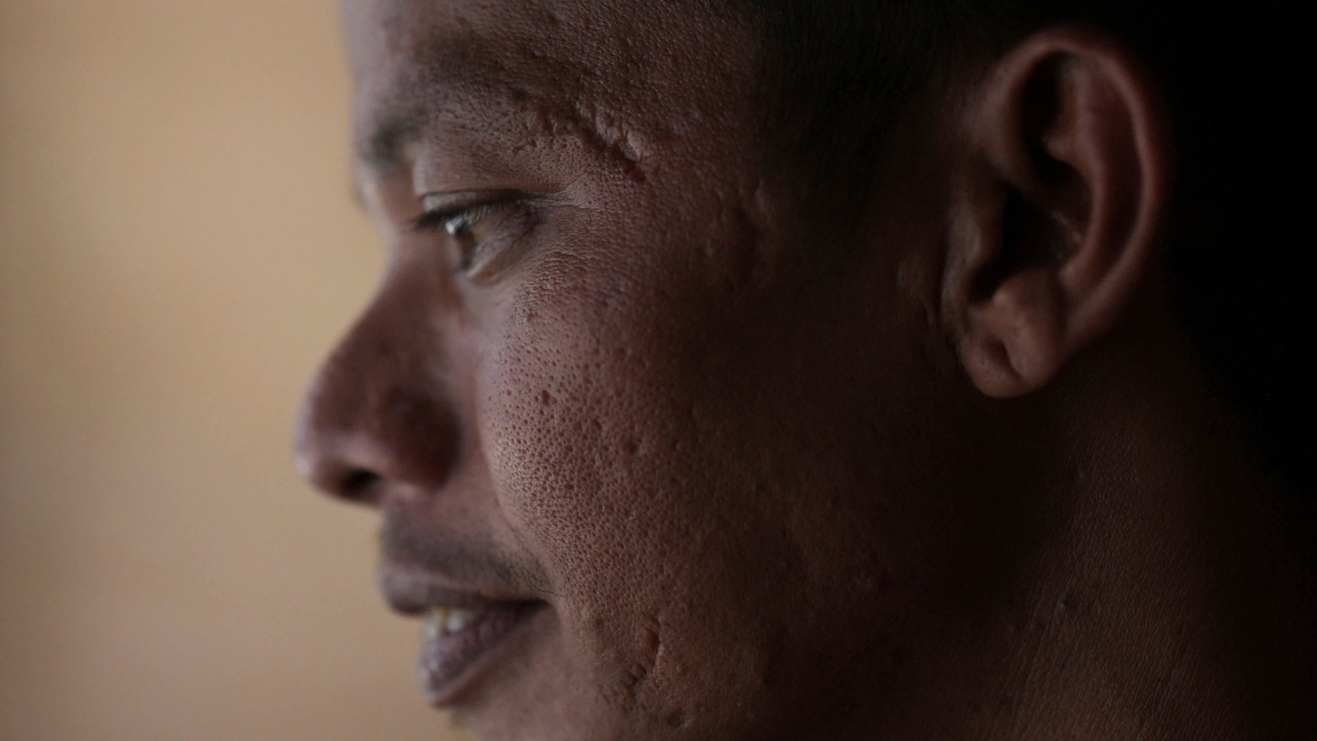 Suardi, a crocodile attack survivor, shows the scars on his face in Budong-Budong, West Sulawesi, Indonesia, Monday, Feb. 24, 2025. (AP Photo/Dita Alangkara)