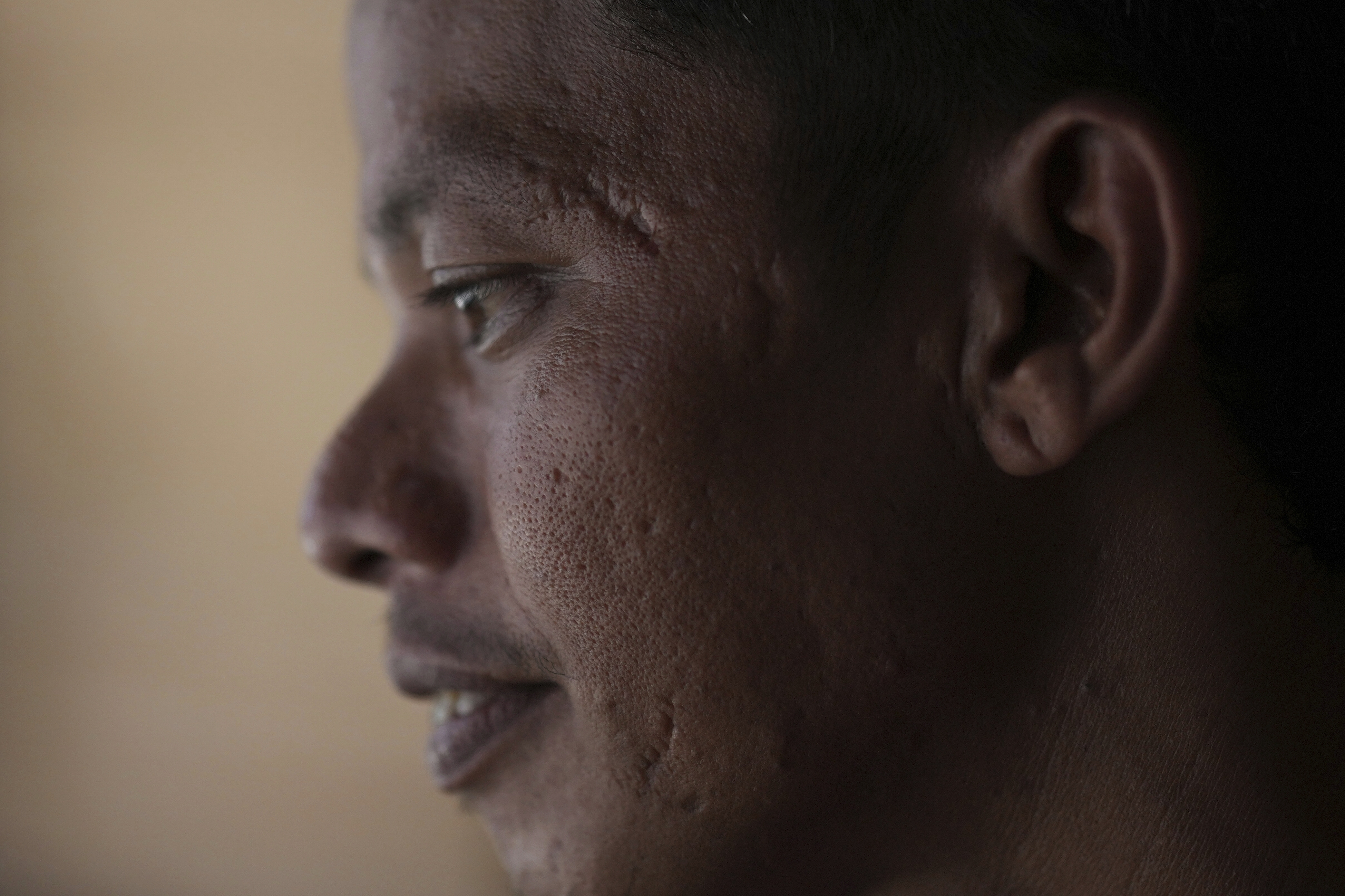 Suardi, a crocodile attack survivor, shows the scars on his face in Budong-Budong, West Sulawesi, Indonesia, Monday, Feb. 24, 2025. (AP Photo/Dita Alangkara)